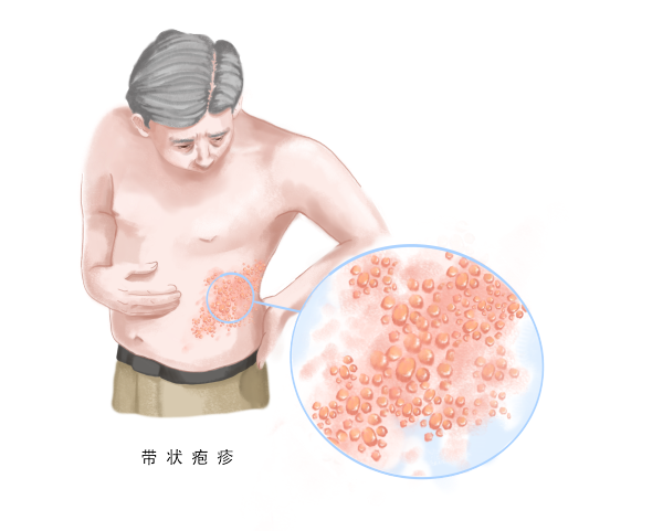 好消息！漳州第三医院成人接种门诊疫苗再+1，6月8日起，带状疱疹疫苗可打
